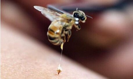 蜜蜂蜇人